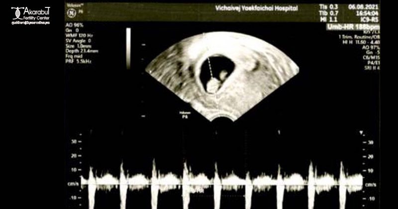 ตั้งครรภ์สำเร็จจากการทำ ICSI ใส่ตัวอ่อน 1 ตัว