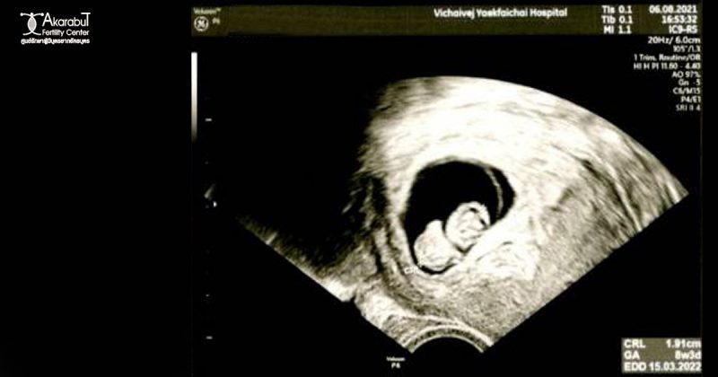 ตั้งครรภ์สำเร็จครั้งแรกด้วย ICSI ใส่ตัวอ่อน 1 ตัว กับคุณหมอณิชมน